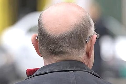 Bald Head