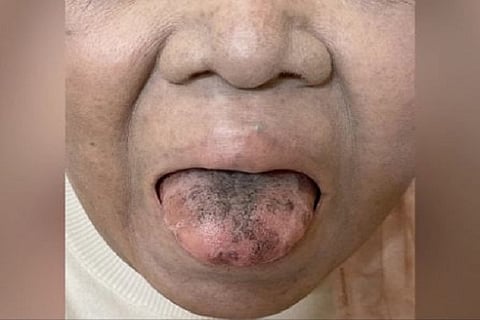 black tongue