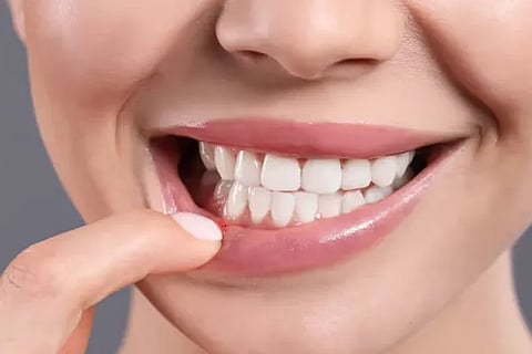 mouth ulcer