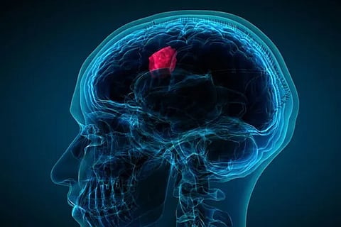 Brain Tumor