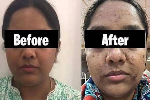 Facial