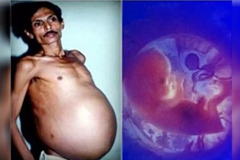 Nagpur Man Pregnant
