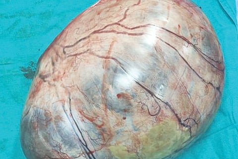The doctor removed the 6 kg tumor