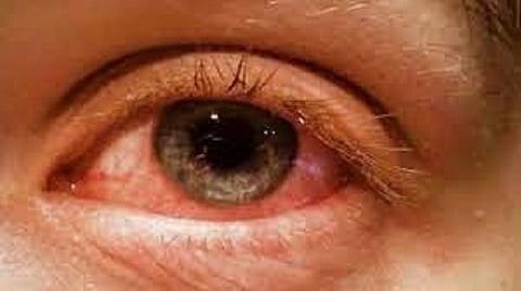 madrass eye
