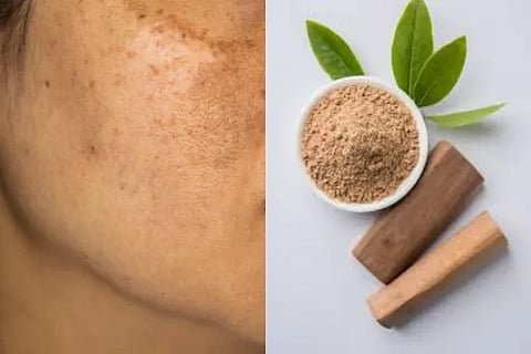 pigmentation