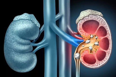 Kidney Stones