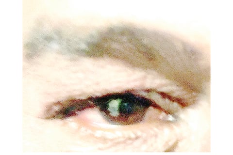 Madras eye infection on the rise