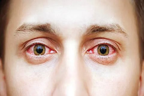 Pink Eye