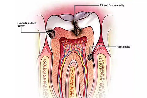 Tooth Pain
