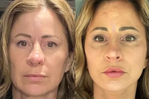 Woman Sells House To Get Facelift Surgery Now Lives In Van