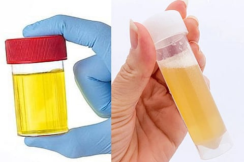 foamy urine 1