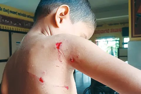 stray dogs bit child injured