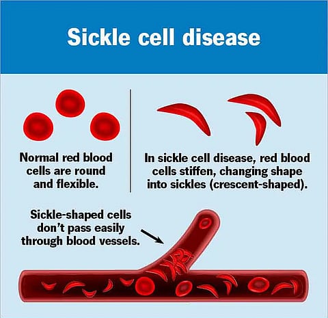 sickle-cell-disease