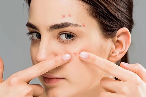 Acne Kiss