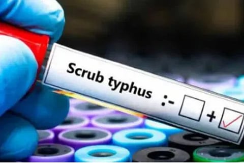 Scrub Typhus