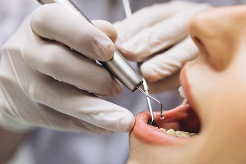 root canal (1)