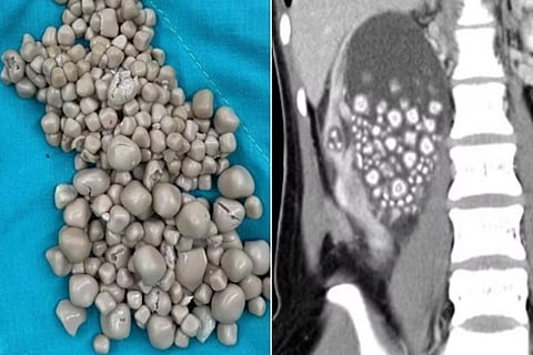 Kidney Stones