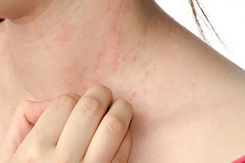Urticaria