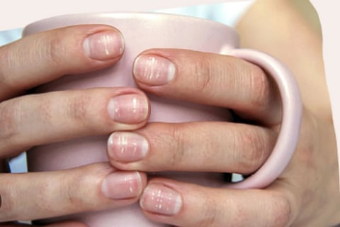 ]white patches nails