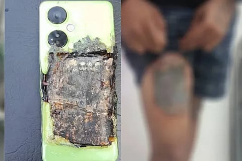 Mobile blast injures a young man's thigh in Bangalore