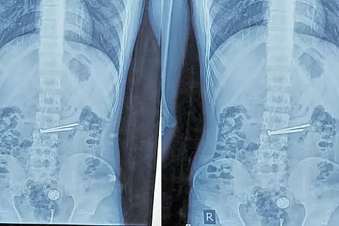 OGH doctors remove nails from Chanchalguda Jail prisoner’s stomach