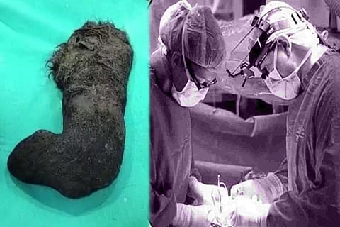 Hair in Stomach
