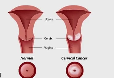 cervical