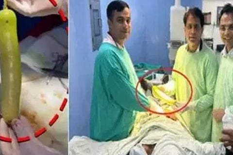 Doctors Remove 16 Inch Lauki from Mans Rectum After 2 Hour Operation In Madhya Pradesh