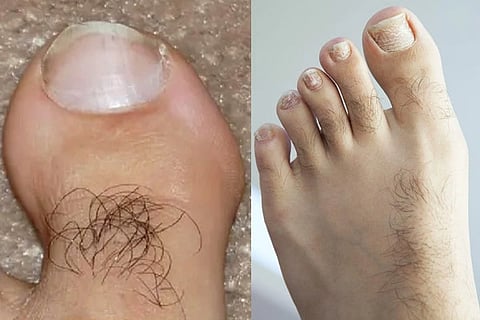 Hair on your toes