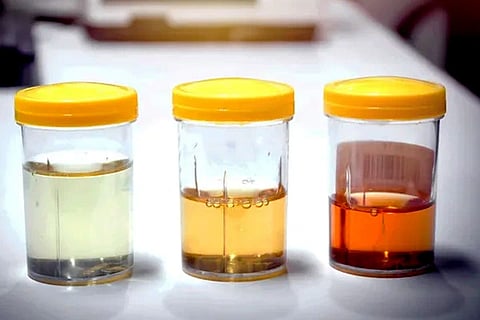 Urine Color