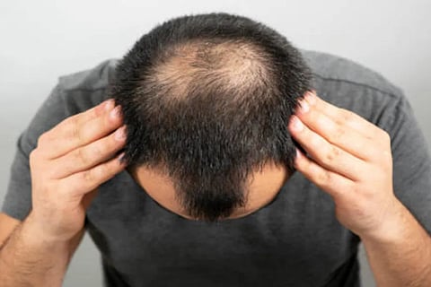 baldness