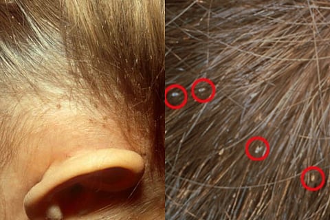 lice