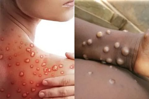 monkeypox