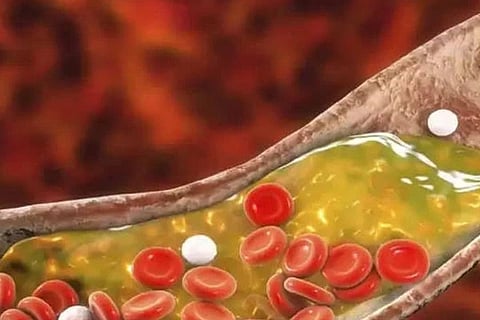 Bad cholesterol