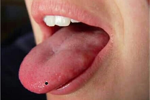 mole on tongue