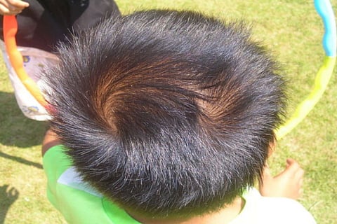 whorlhead