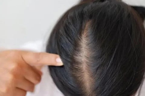 hair loss