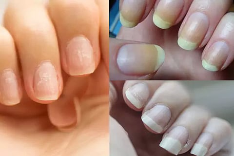 Fingernails