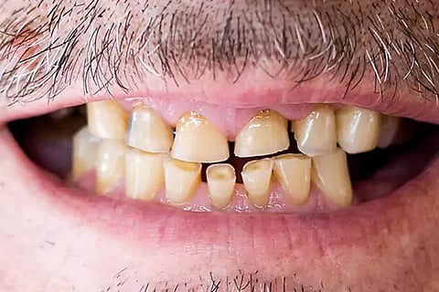 Teeth Health
