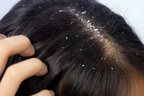 dandruff