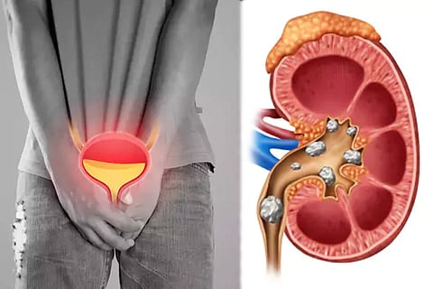 Kidney Stones