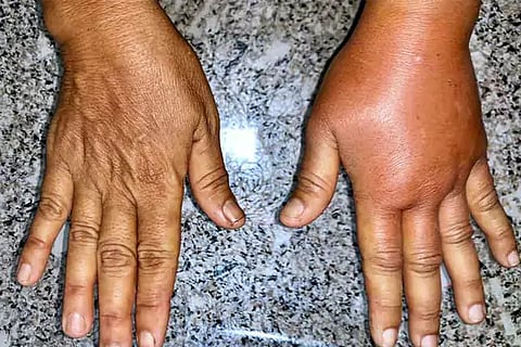 Legs and Arms Swollen