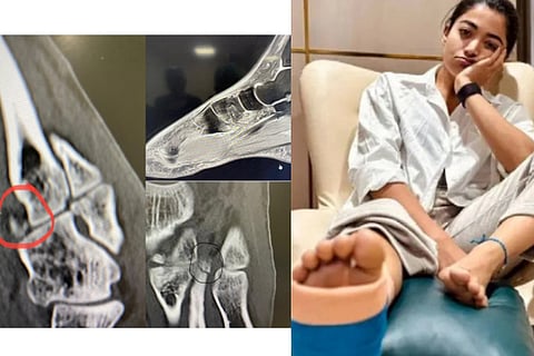 Rashmikas Leg