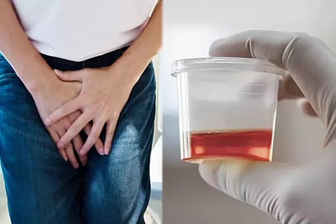 Blood In Urine