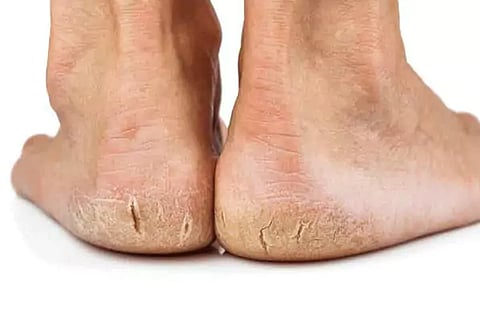 Cracked Heels