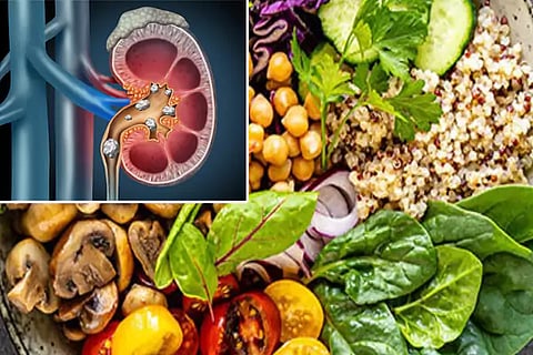 Kidney Stones