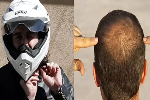 Hair Loss