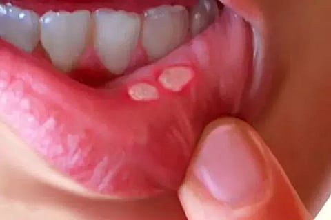 Mouth ulcers