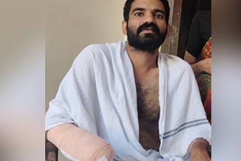 A simple fish bite turns tragic Kerala man loses palm to rare infection