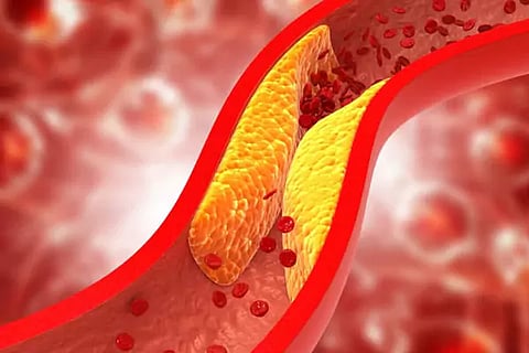 Bad cholesterol